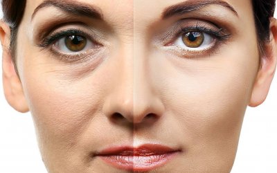 ¿Que es la Blefaroplastia?