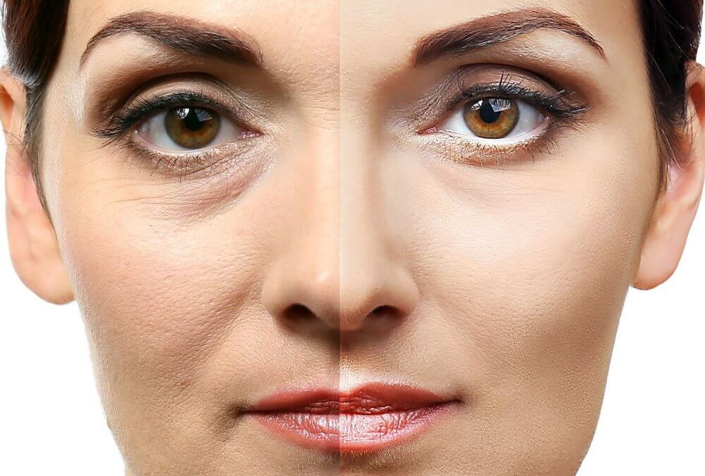 ¿Que es la Blefaroplastia?