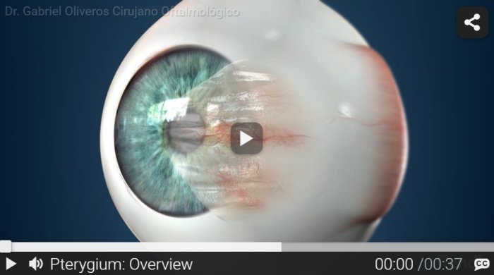 RND - Pterygium - Overview RND - Pterygium - Overview