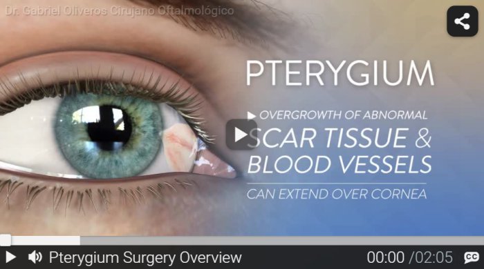 RND - Pterygium Surgery Overview RND - Pterygium Surgery Overview