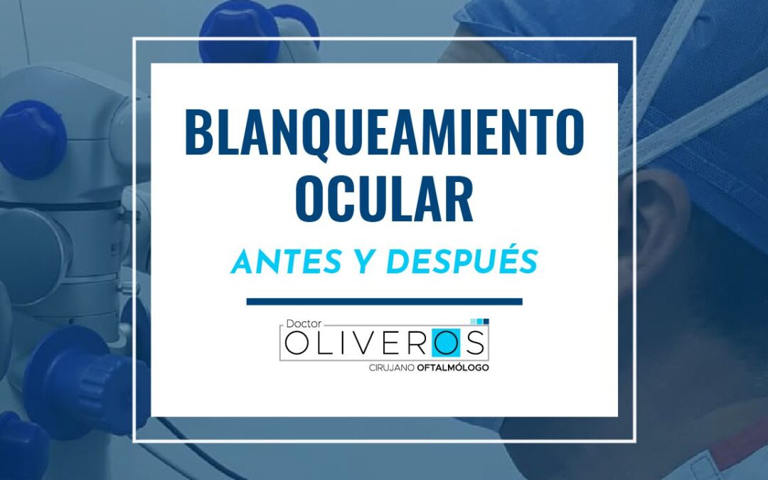 Testimonios de Blanqueamiento Ocular
