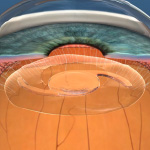 Astigmatismo - Dr Gabriel Oliveros